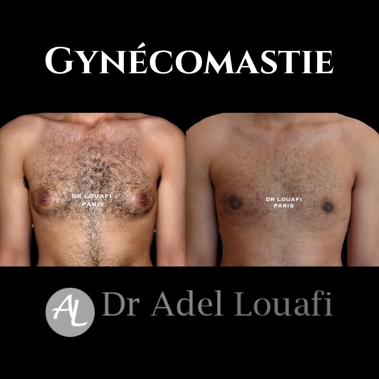 gynécomastie photo avant après homme