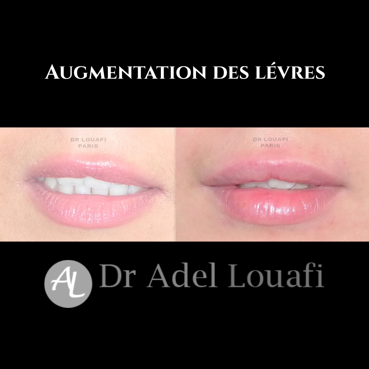 Augmentation lèvres acide hyaluronique