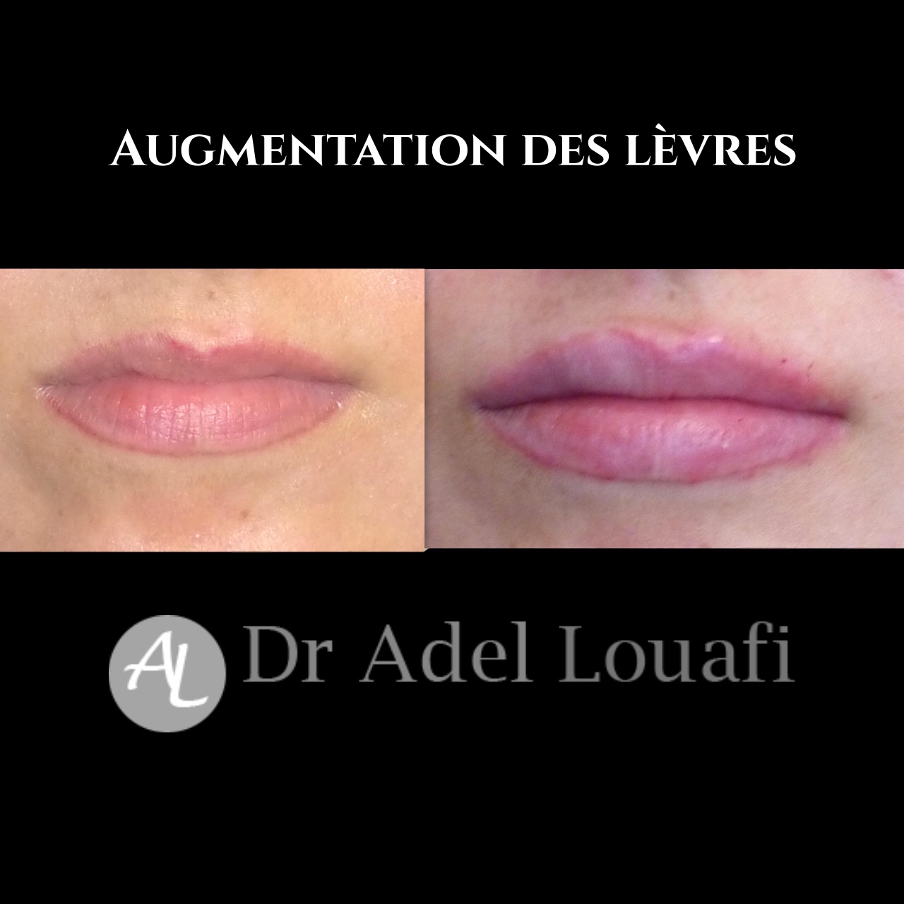 Augmentation lèvres acide hyaluronique 3