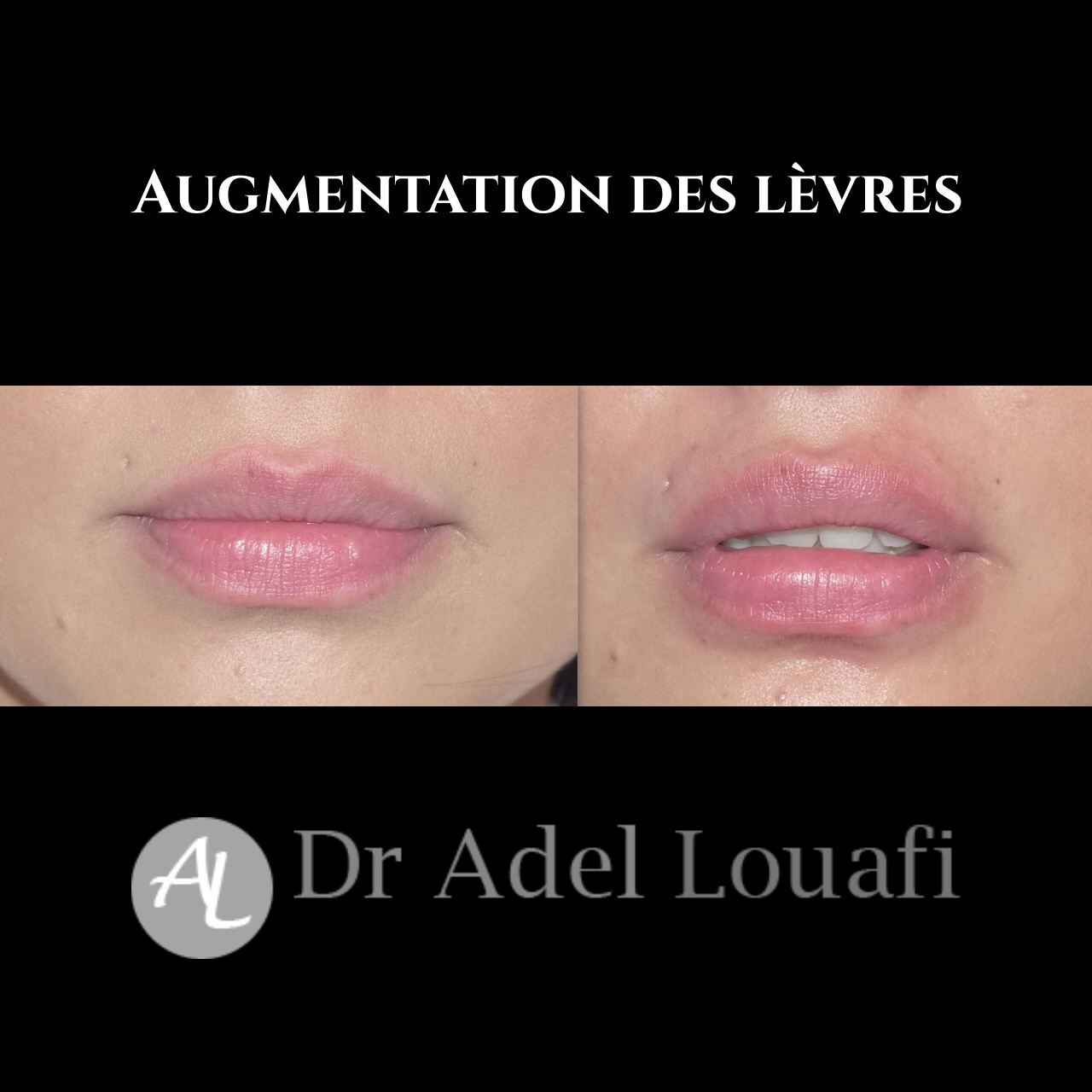 Augmentation lèvres acide hyaluronique 5