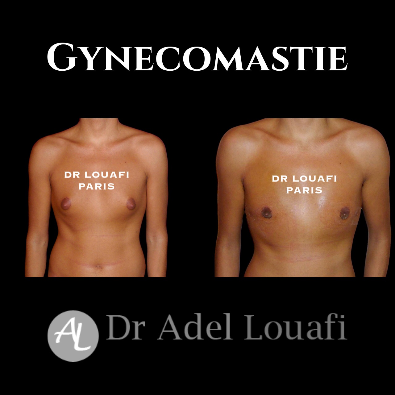 gynecomastie avec le dr Louafi