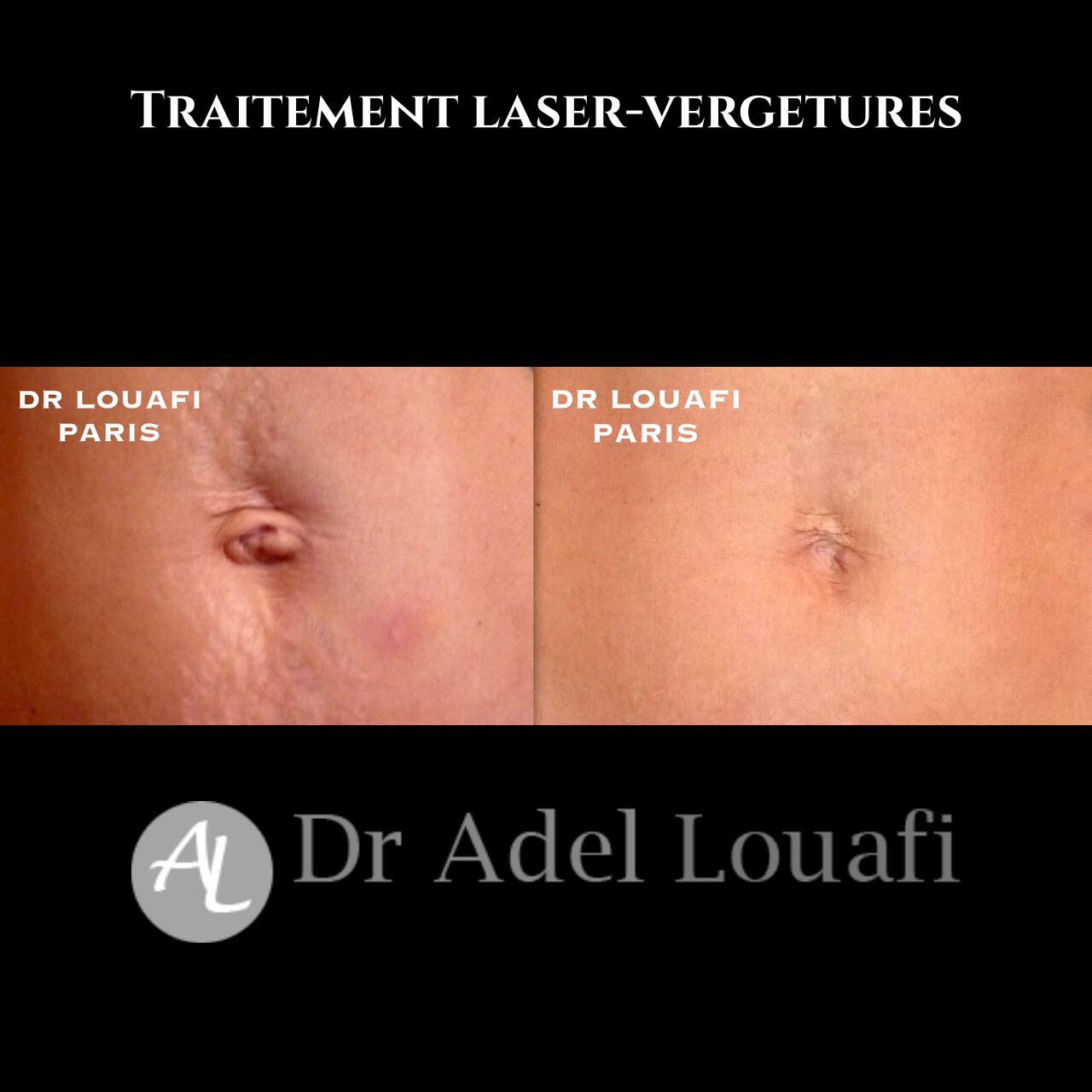 laser vergetures