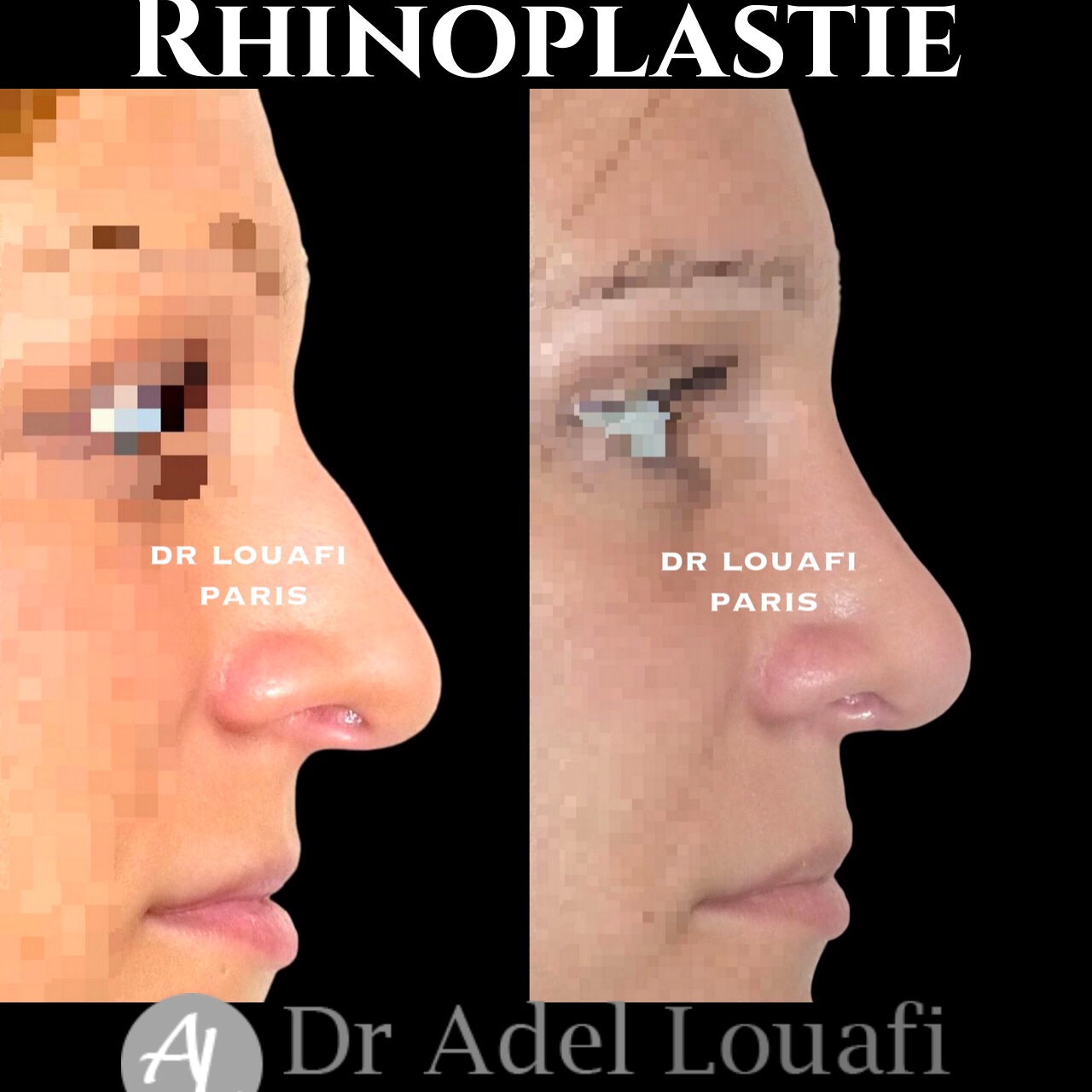 photo avant apres rhinoplastie femme