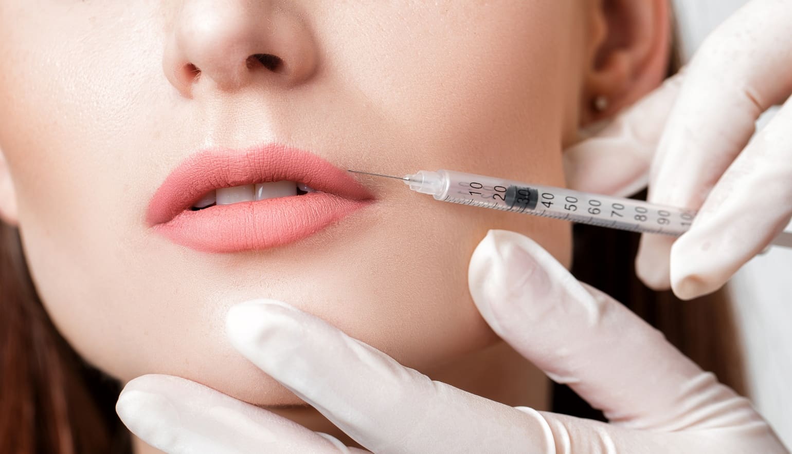 Injections d'acide hyaluronique des lèvres | Paris | Dr Louafi
