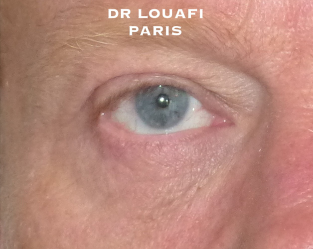 blepharoplastie photo after