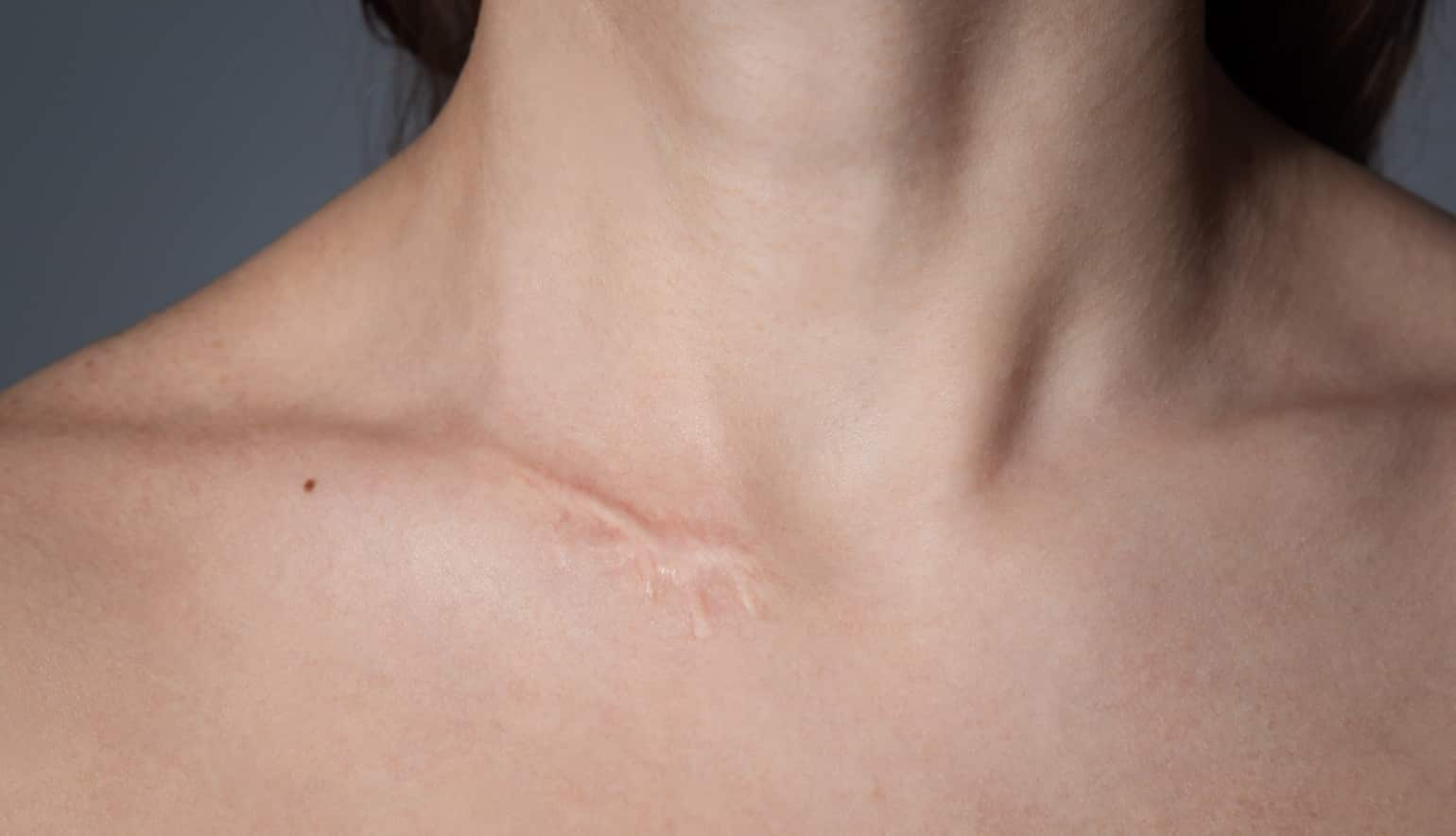Traiter les cicatrices : traitement laser | Technique | Paris | Dr Louafi