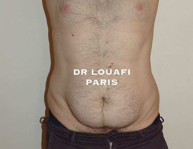 photo lipoaspiration before