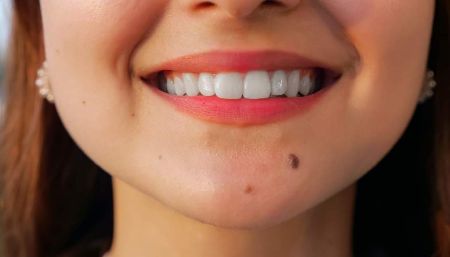Le Dr Louafi vous explique comment retirer un grain de beauté sur le visage à Paris
