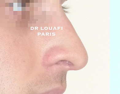 chirurgie du nez après